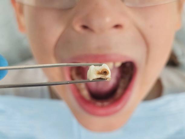 Best Emergency Dental Extractions in Spring Lake, NC